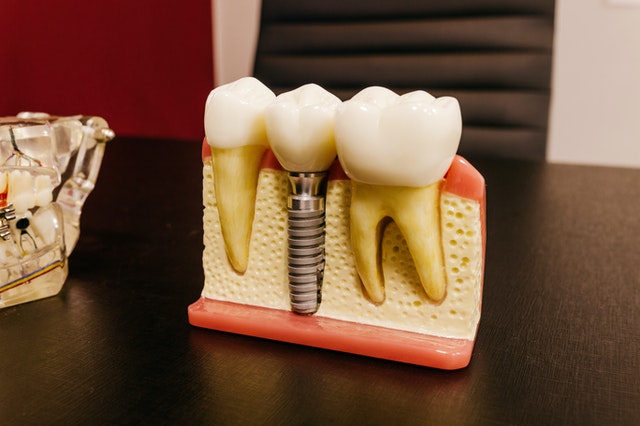 Precio de Implantes Dentales
